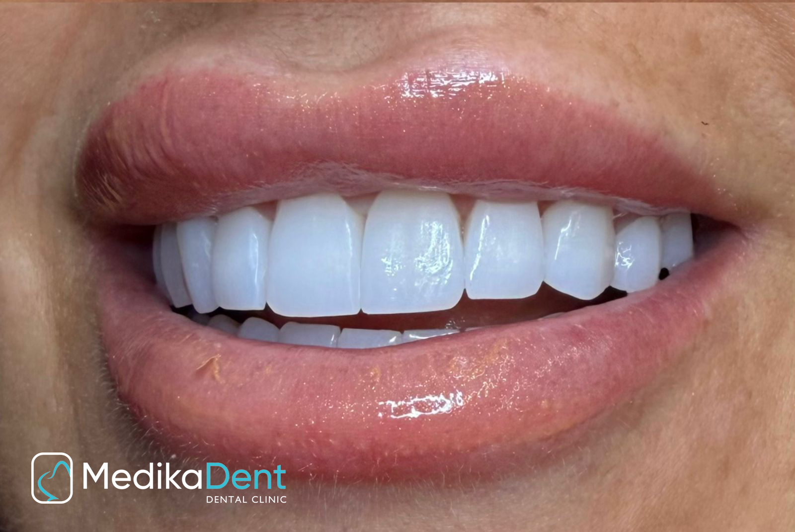 Ortodoncia që ndryshon jetën, trajtime moderne në MedikaDent për buzëqeshje perfekte