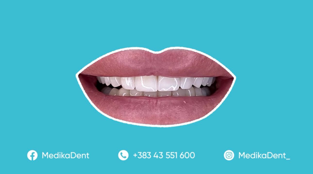 Kurorat e zirkonit: standardi i ri në rikonstruksionin dentar modern